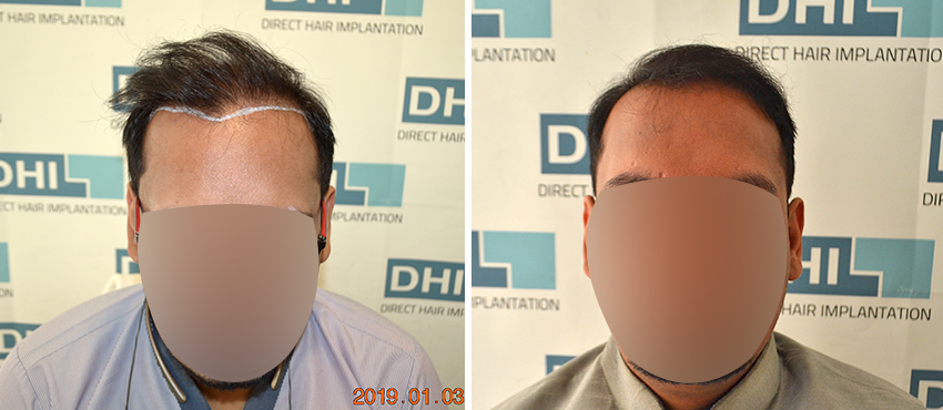 DHI before & after hair transplant results